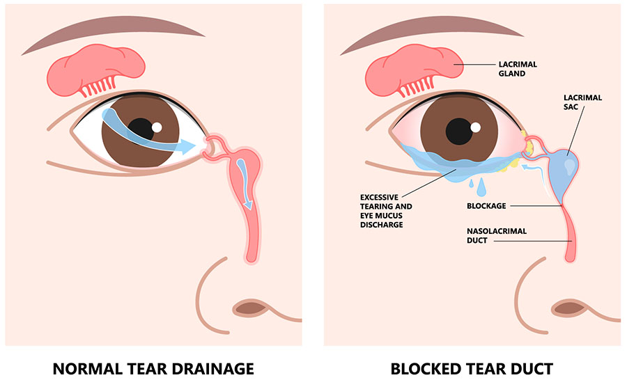 Tear Duct Obstruction Long Beach | Eye Physicians of Long Beach